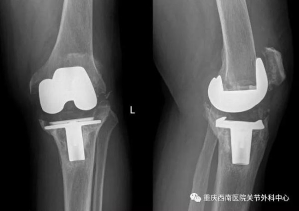 3D打印膝關節